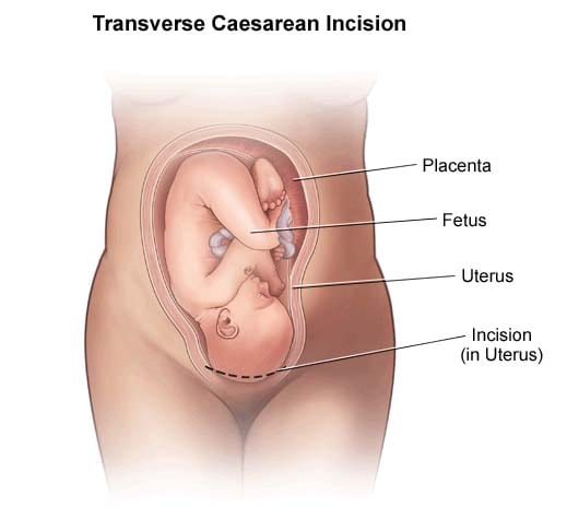 Transverse Cesarean Incision