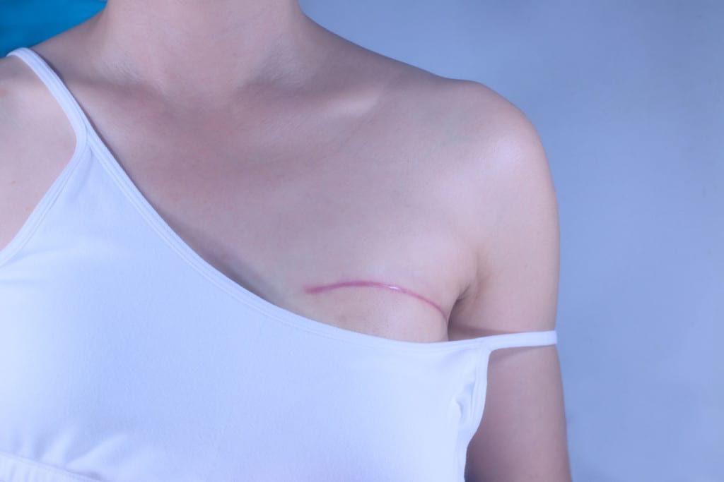 Hidden Scar™ Breast Cancer Surgery: Advanced Cosmetic Procedure Comes to  Touro